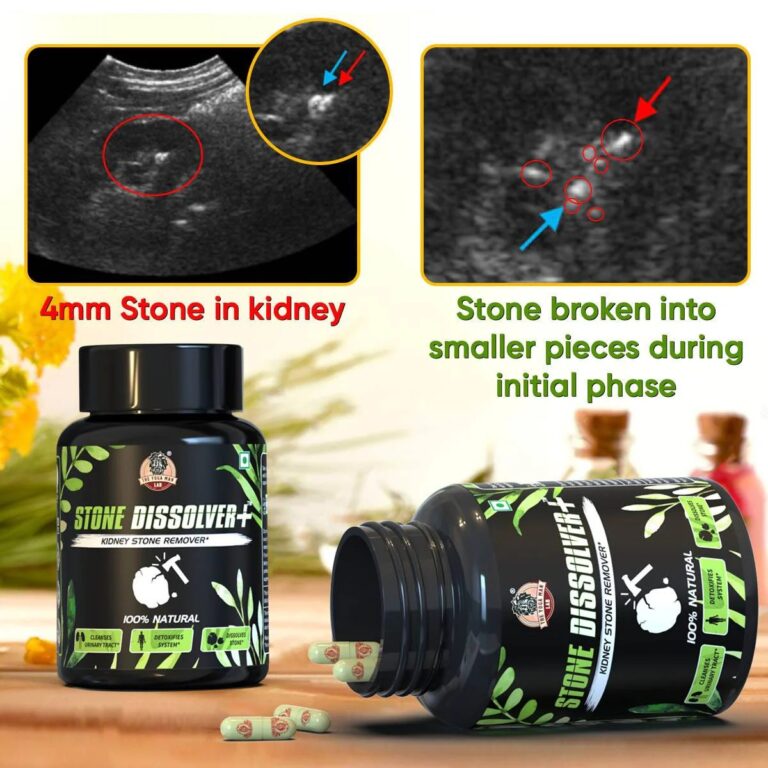 Stone Dissolver+ – Suplemento Natural de Bienestar Renal